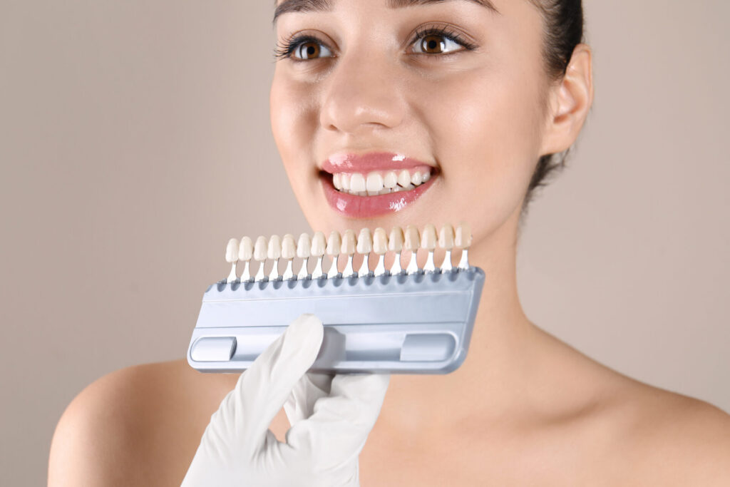 Zahnfarbbestimmung mit Farbskala für natürlich wirkende Veneers